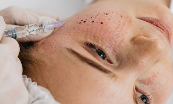 Біоревіталізація